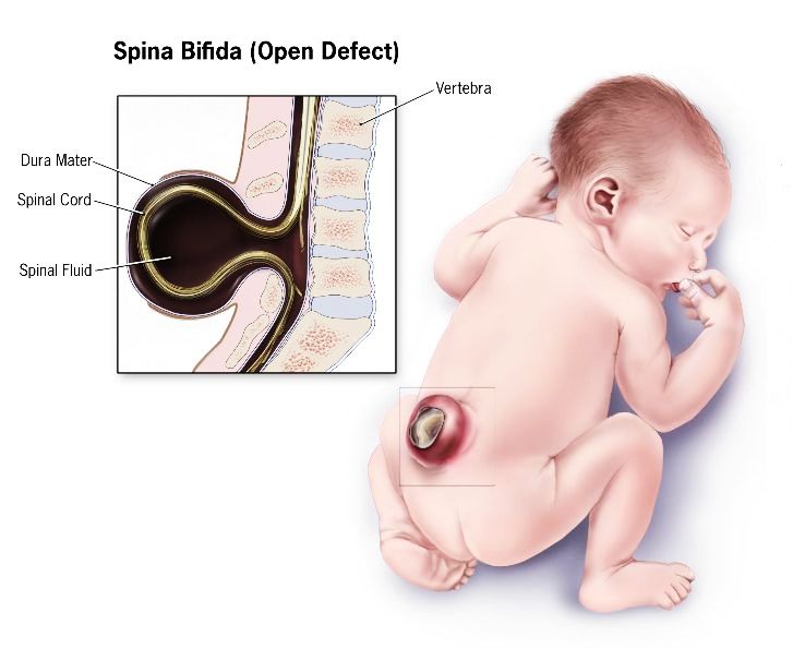 8. Spina Bifidus Operation